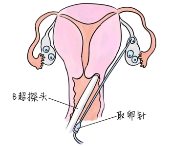 小儿退烧推拿手法 5种北京捐卵宝宝退烧按摩方法